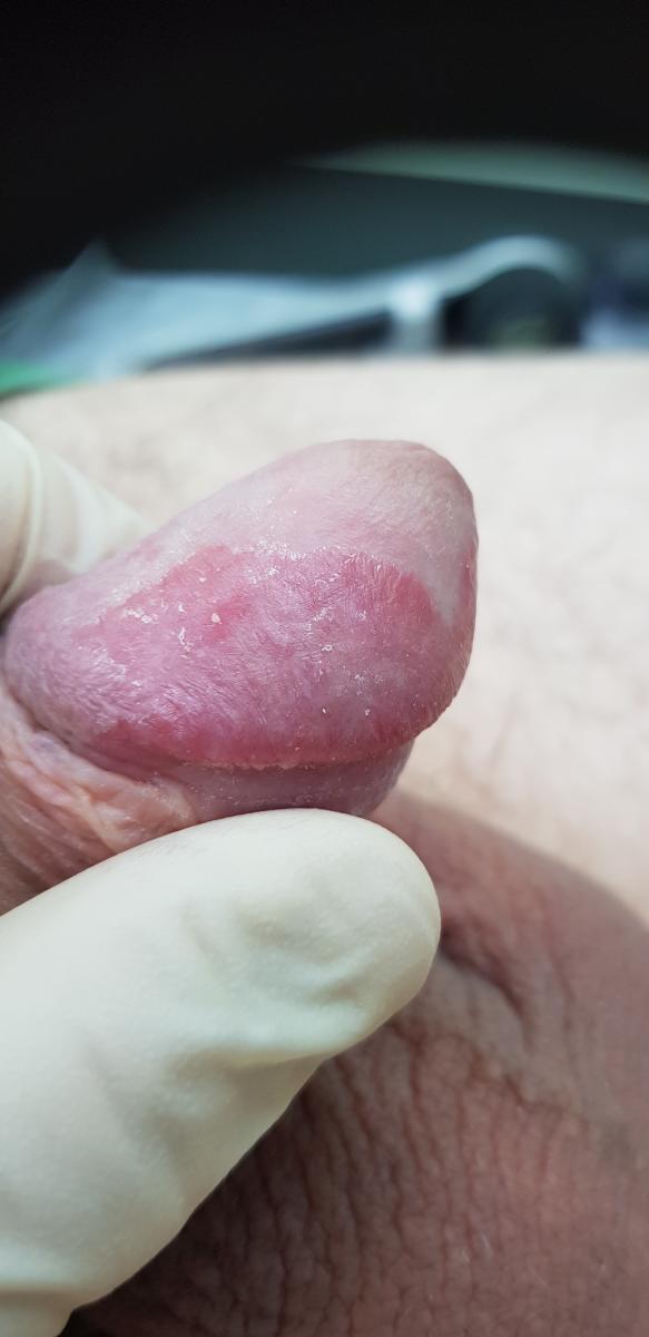 псориаз на головке псориаз