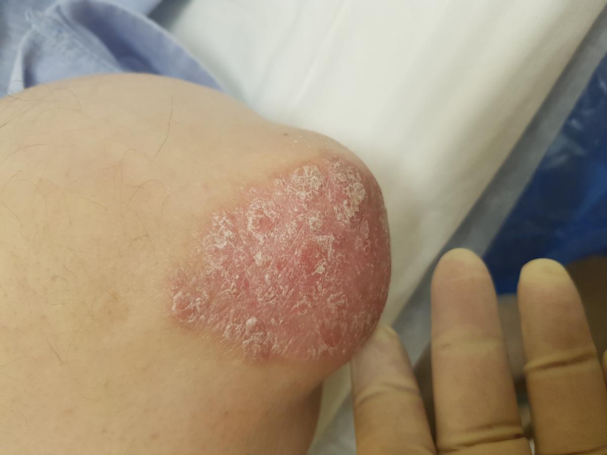 псориаз