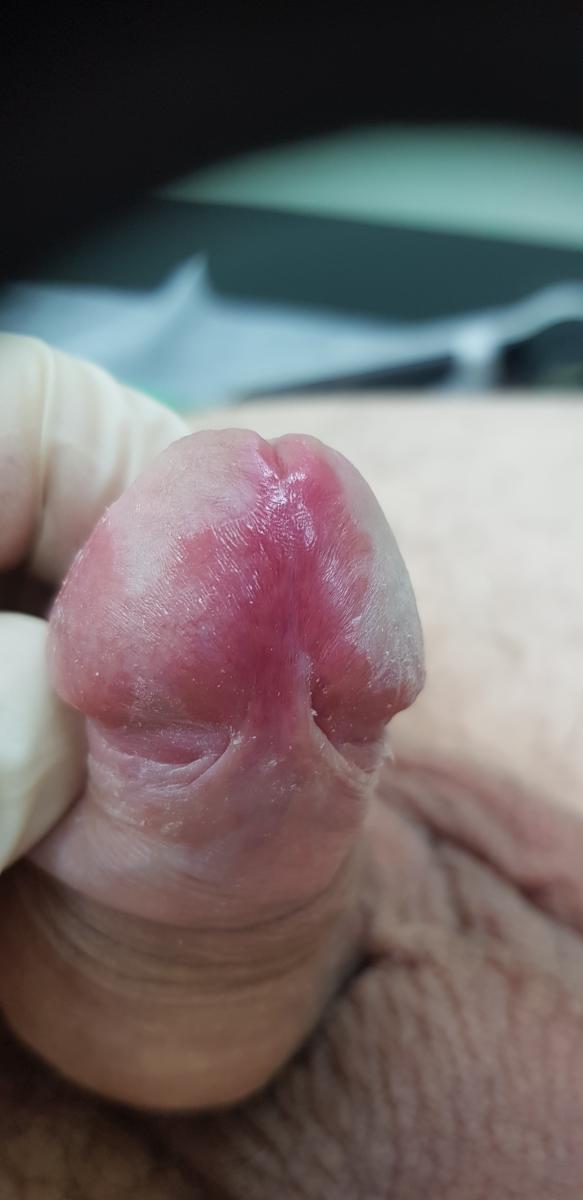 псориаз основания головки псориаз