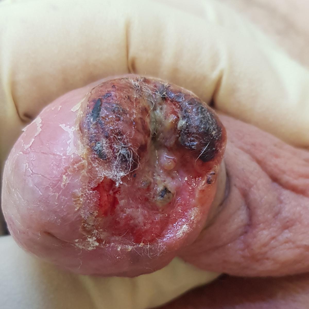 рак головки рак головки члена