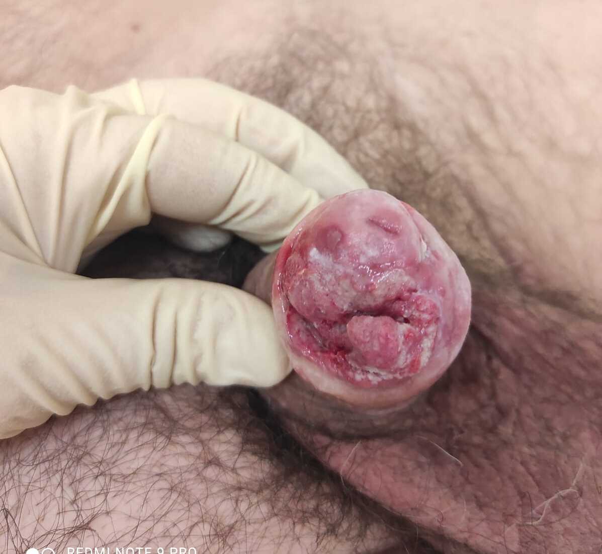 рак рак плоскоклеточный