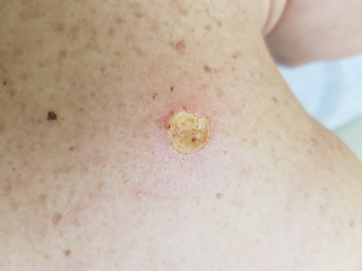 родинка на спине после удаленя