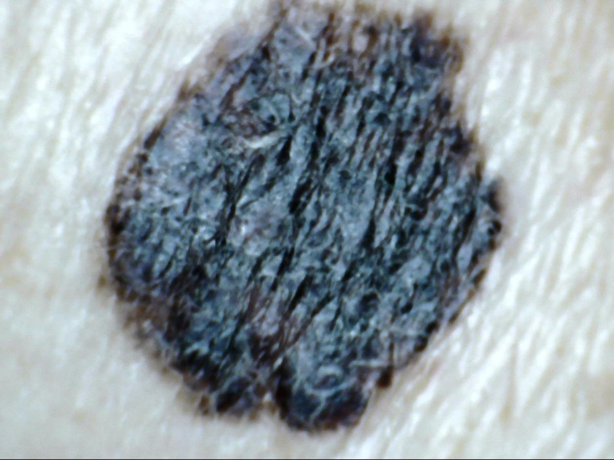 родинка на спине