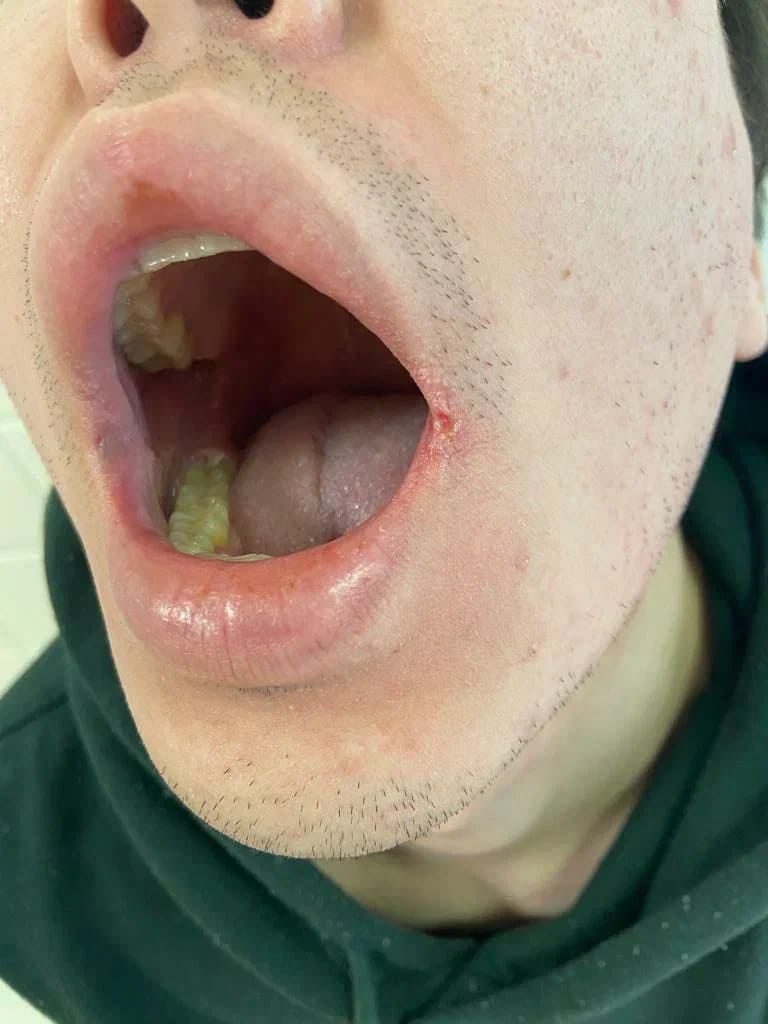 Следы жизнедеятельности бледной трепонемы