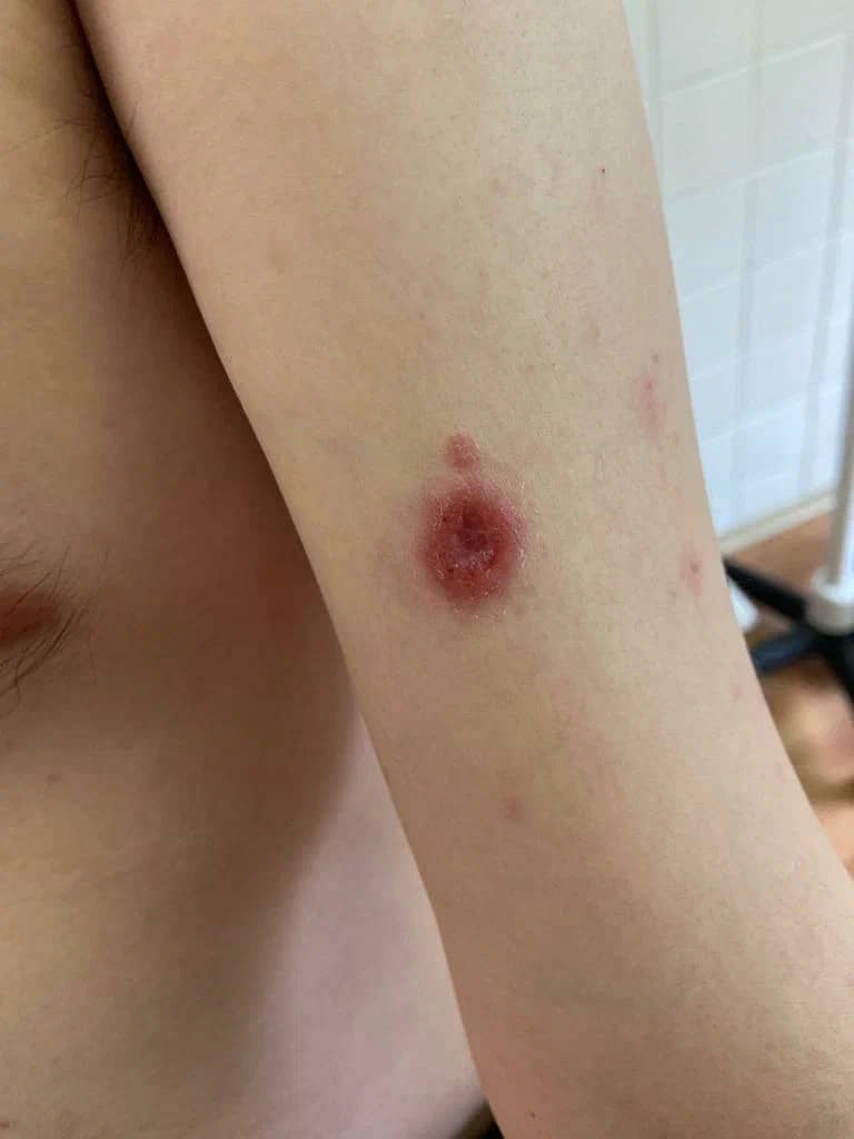 рупиоидный сифилис