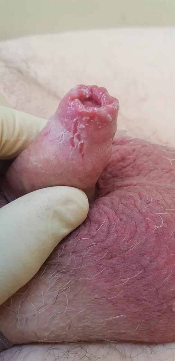 себорейная кератома себорейная кератома