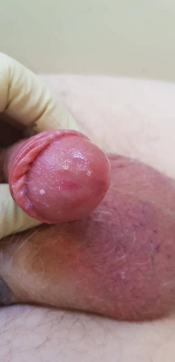 анаэробный баланопостит у мужчин