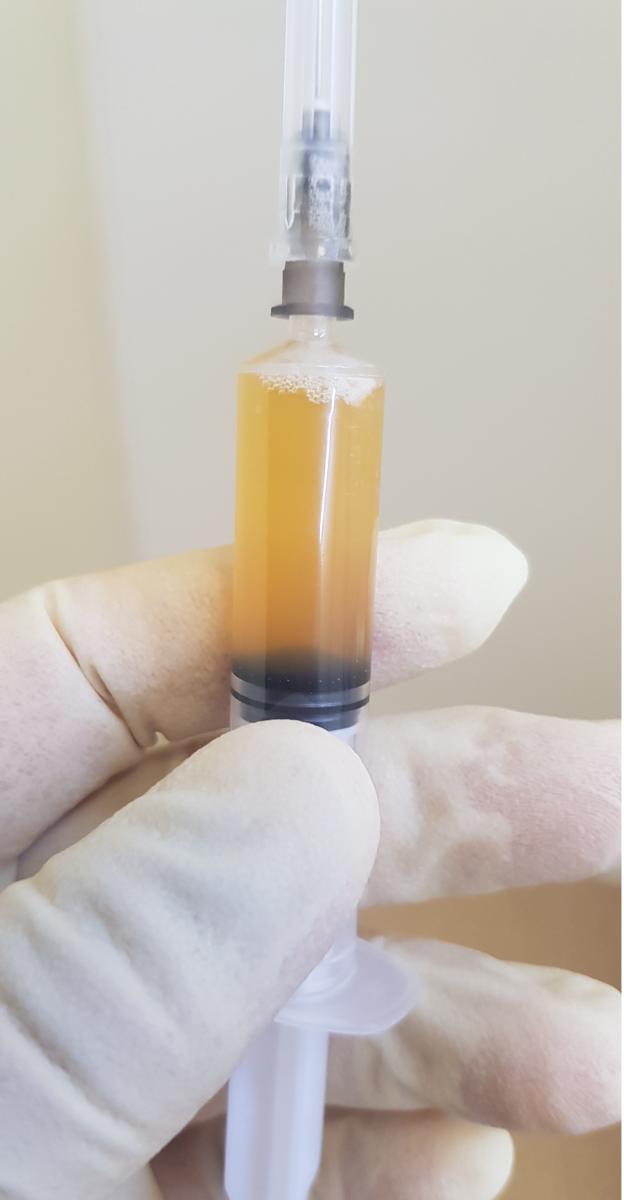 плазмолифтинг