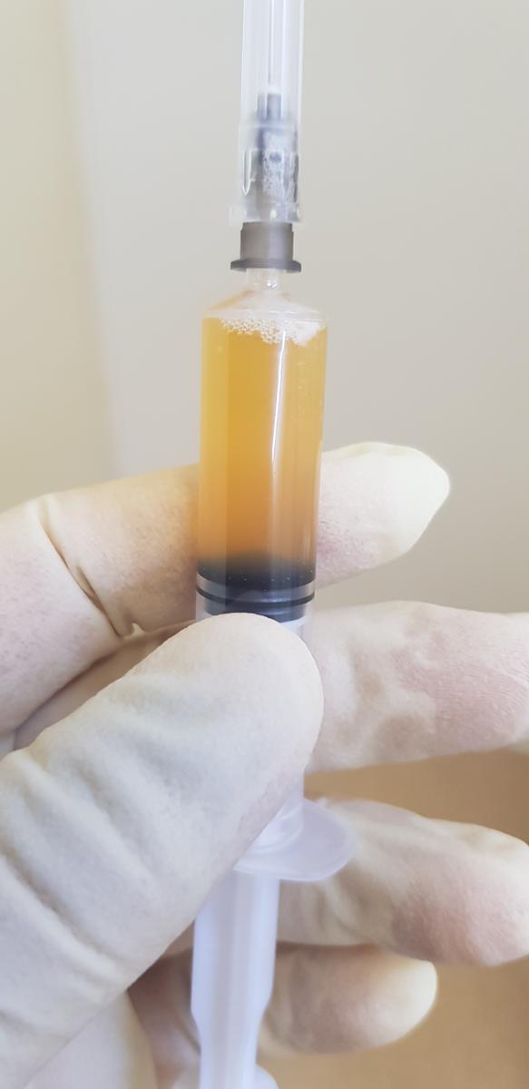 плазмалифтинг плазма крови