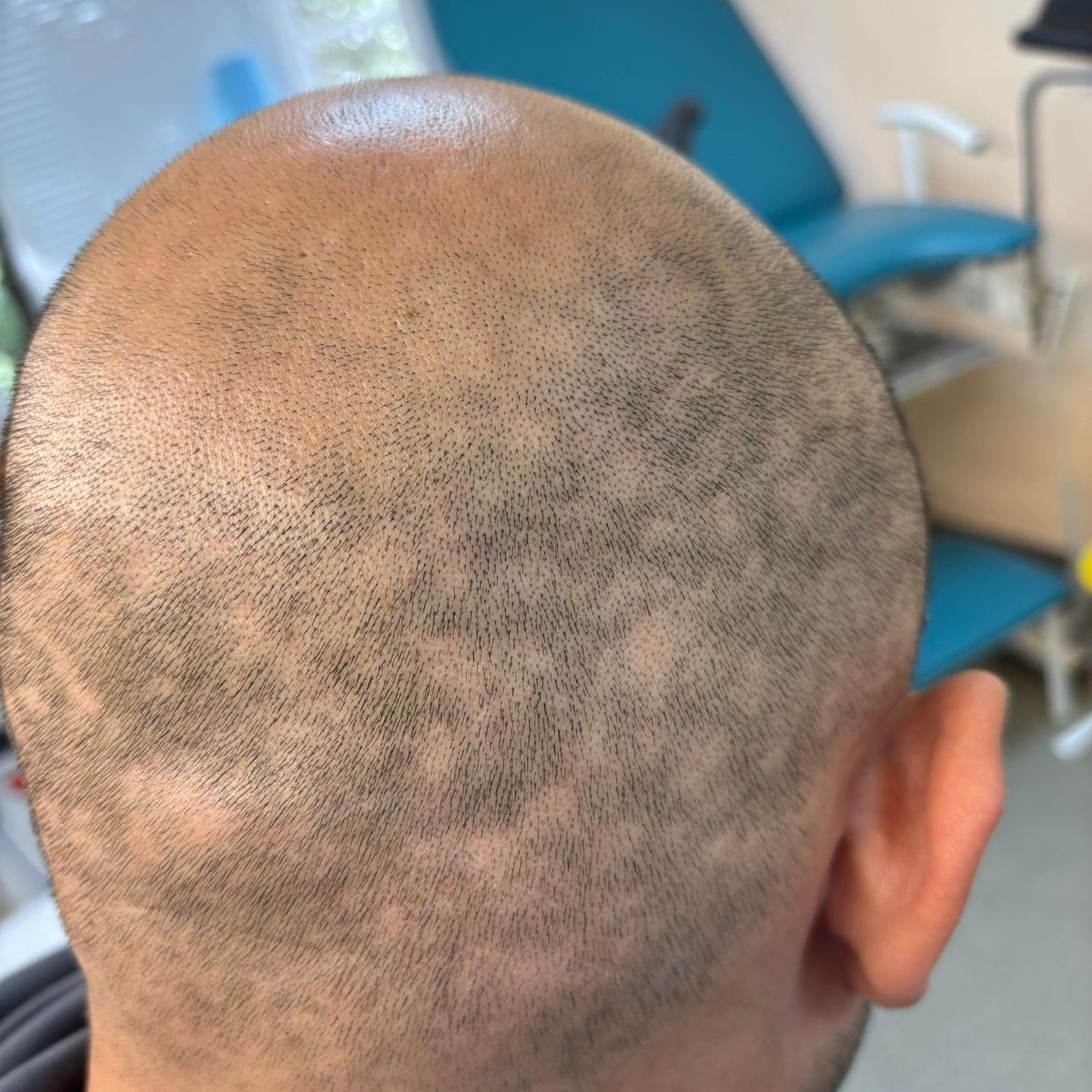 выпадение волос при сифилисе