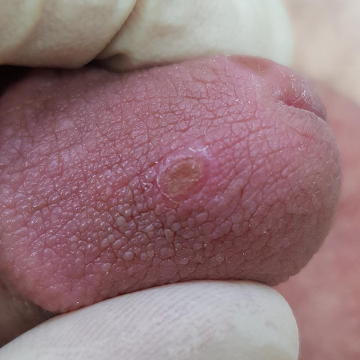 Сифилис головки