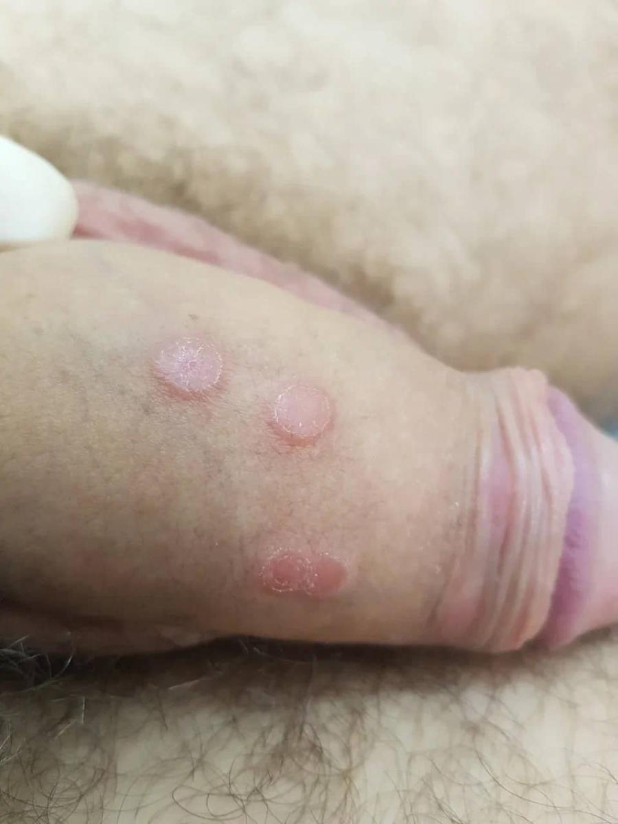 гардасил сифилитические папулы