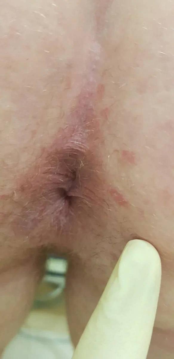 сифилис на слизистых