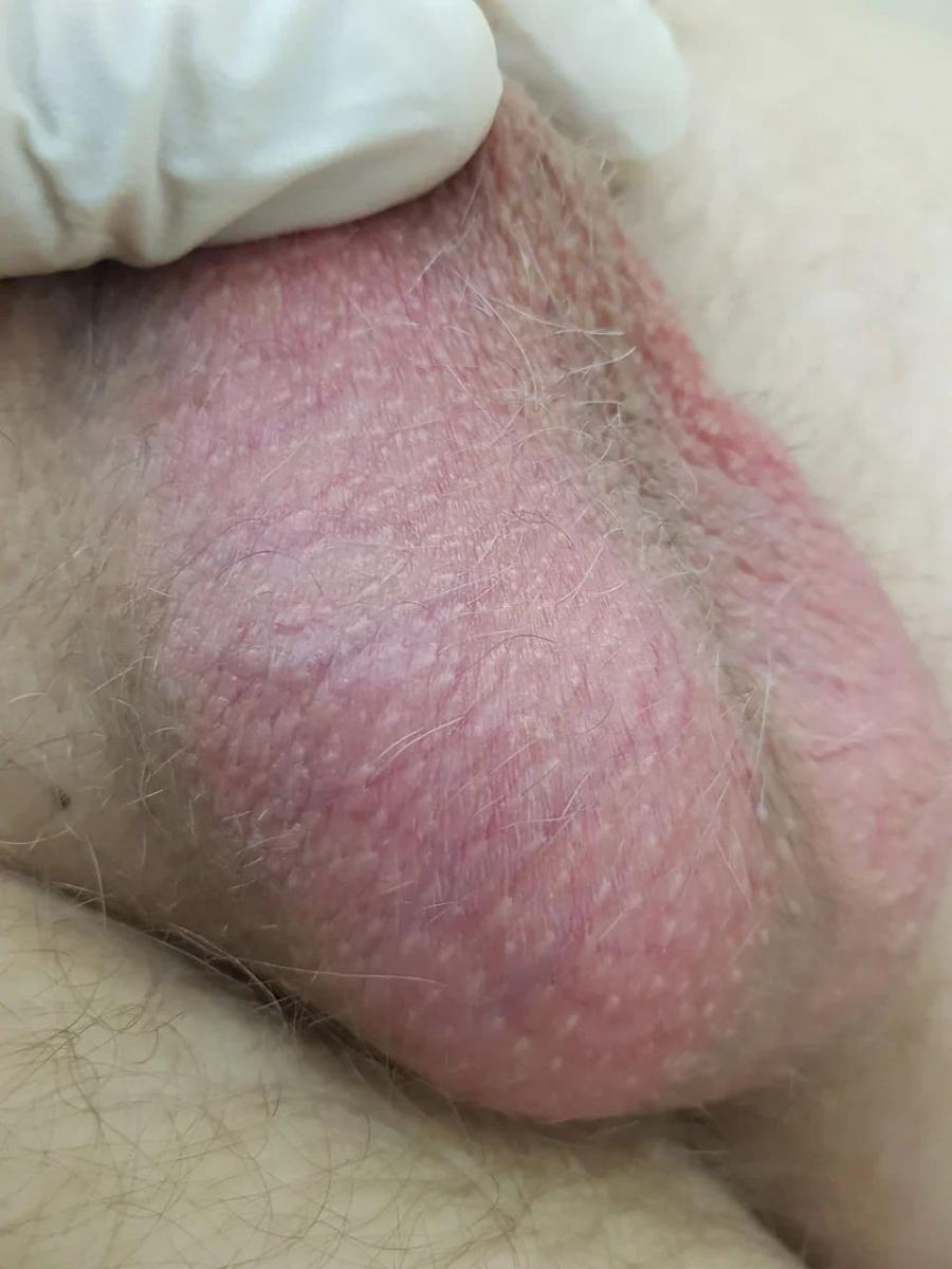 синдром красной мошонки