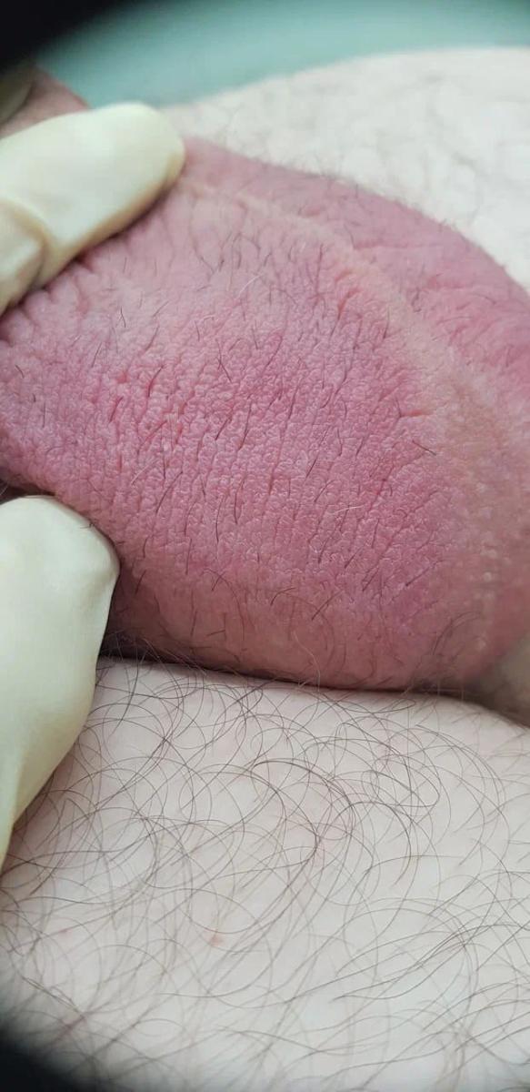 симптомы гонореи