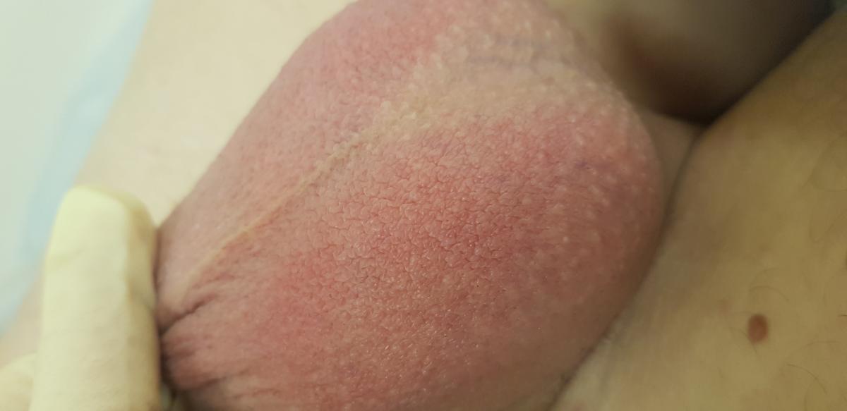 красная мошонка