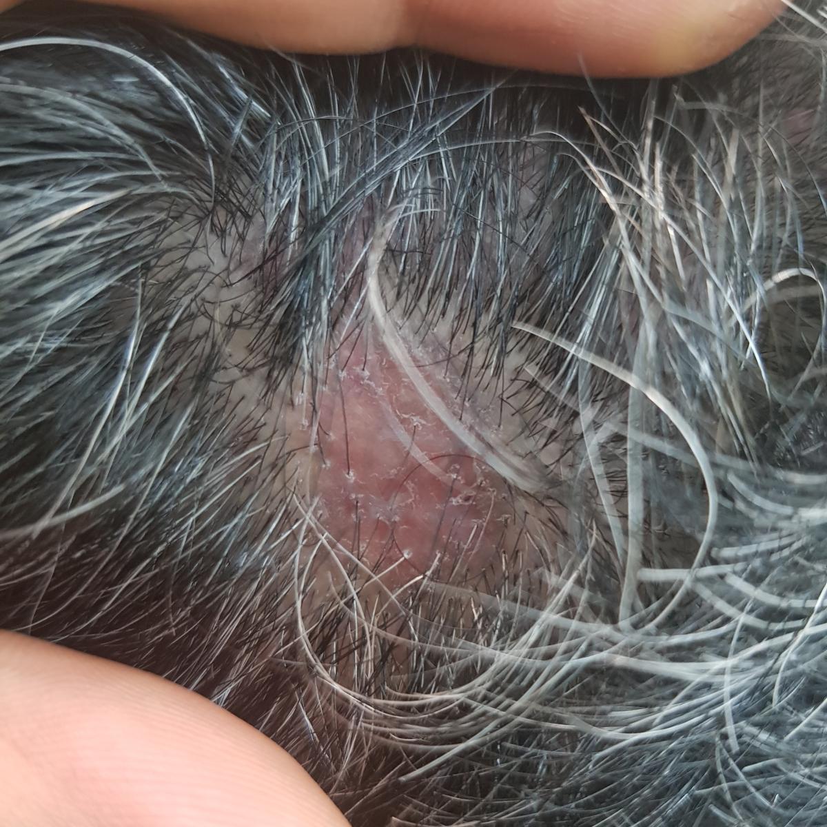 болячки на голове