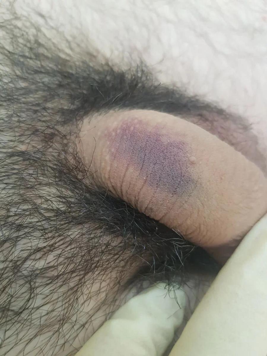 Травматизация Травматизация