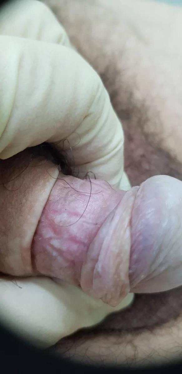 травмы члена опухание при травме члена