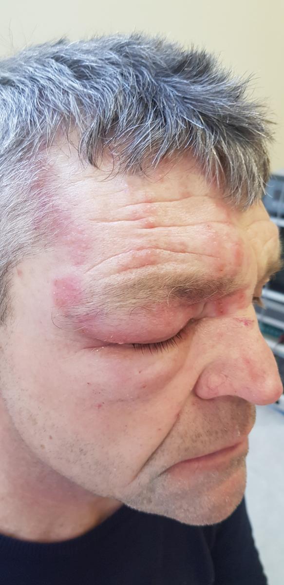 вторичный сифилис