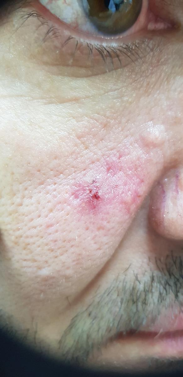 Розеолы на лице при сифилисе 