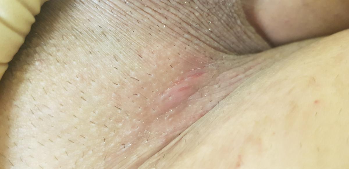 Лечение растяжек