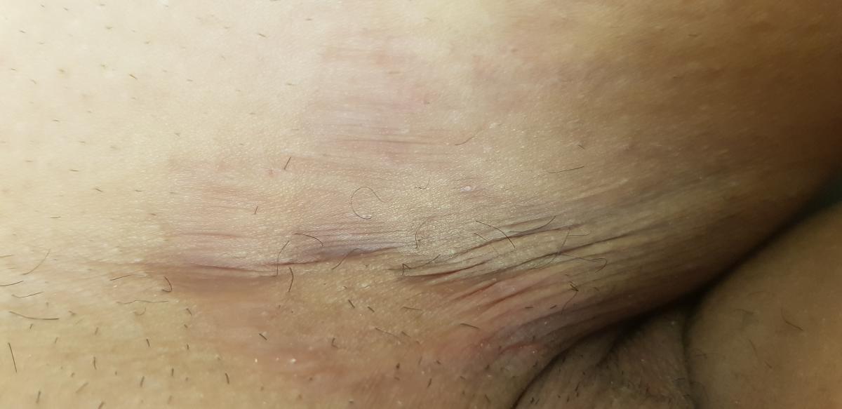 Лечение растяжек 