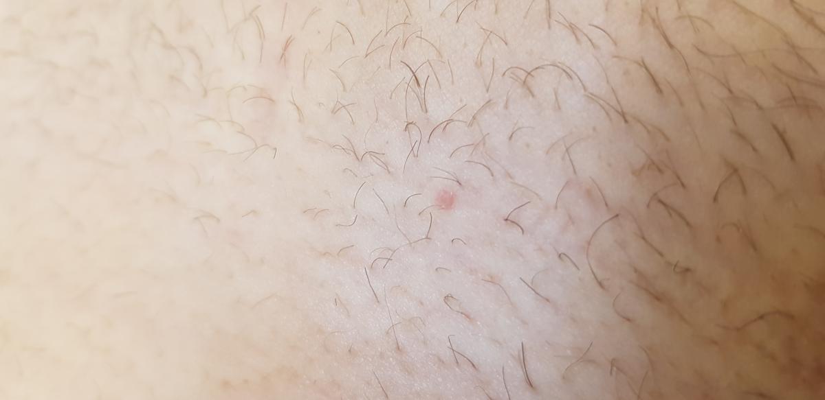 прыщ в основании члена Травмированный прыщ