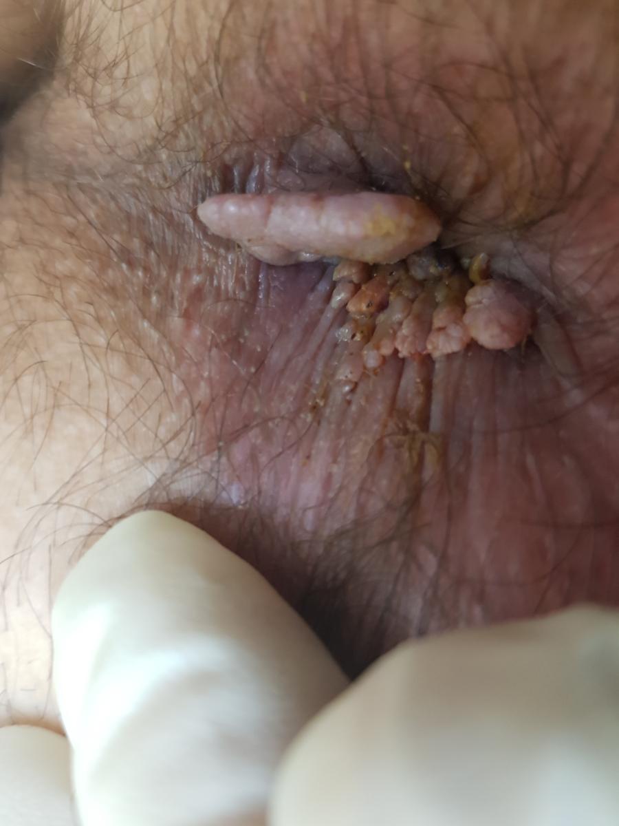 кондиломы ануса