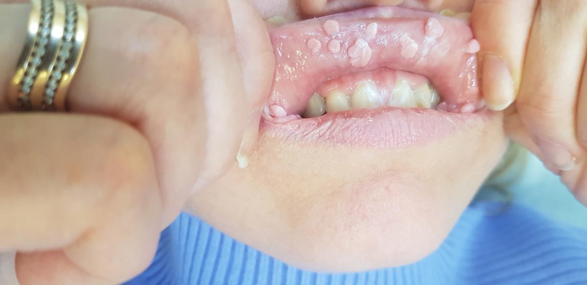 Удаление бородавок во рту Удаление бородавок