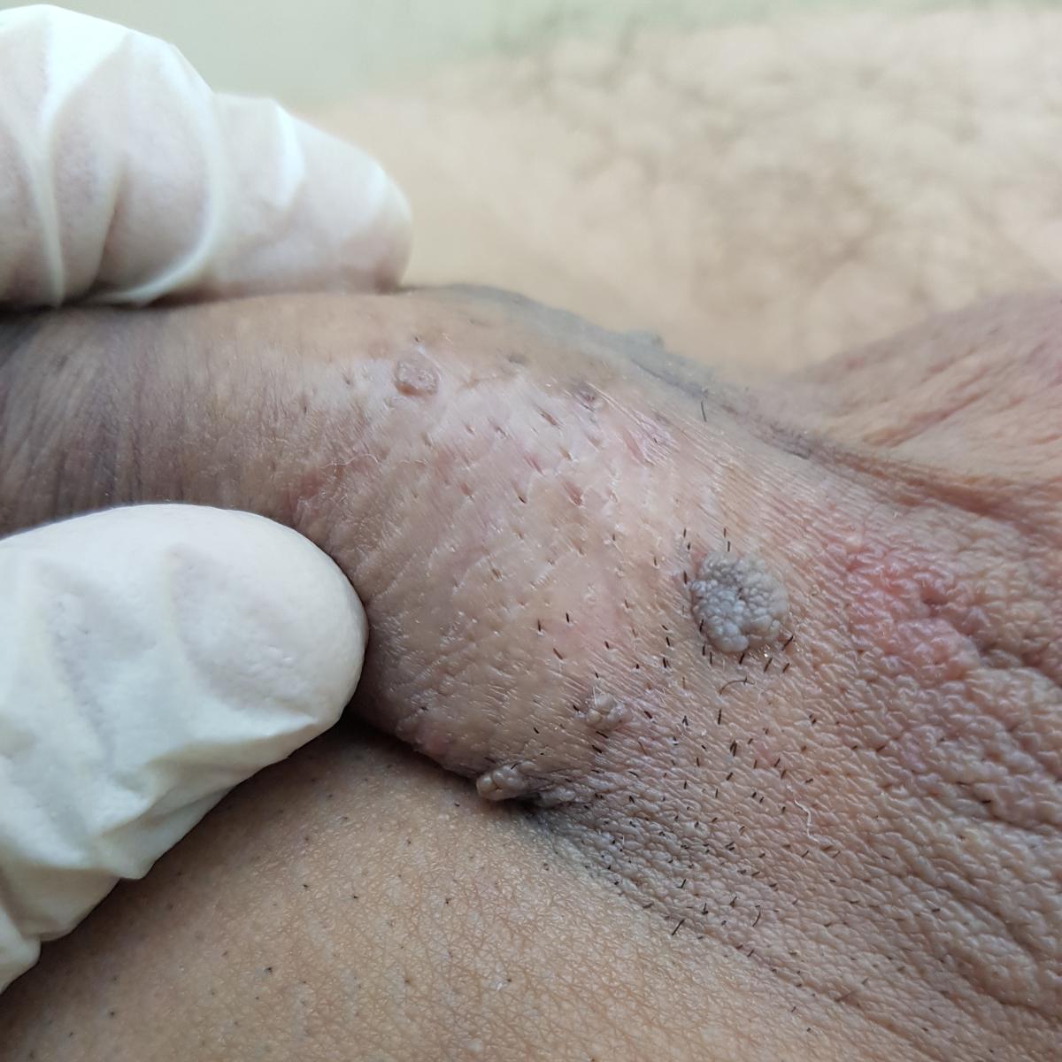 Удаление кондилом Удаление кондилом