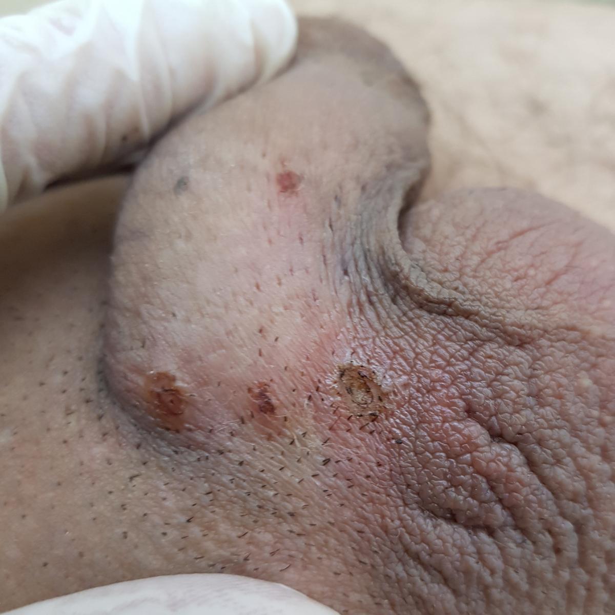 Удаление кондилом Удаление кондилом