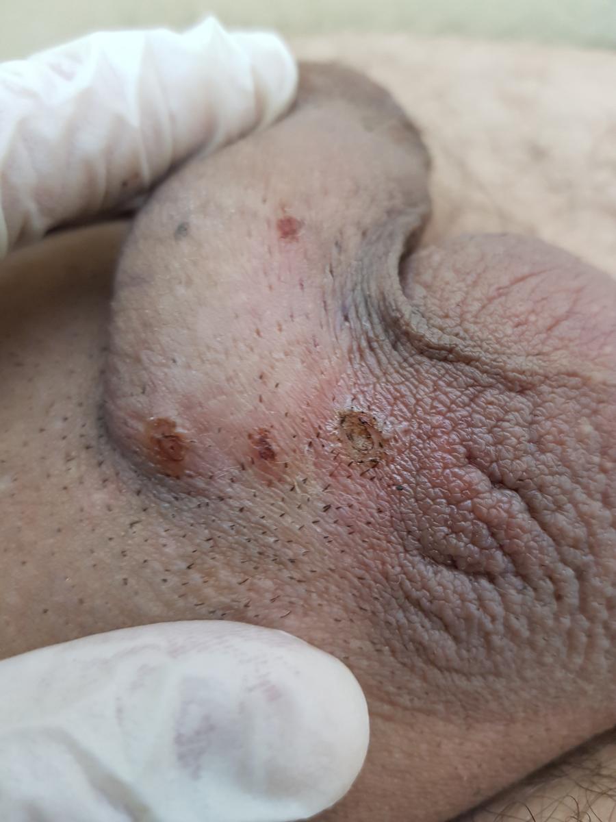 УДАЛЕНИЕ ВПЧ