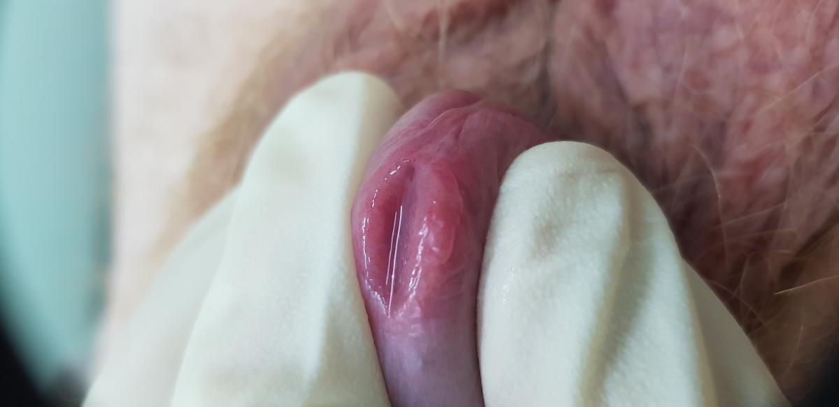 Схематическое изображение простатита