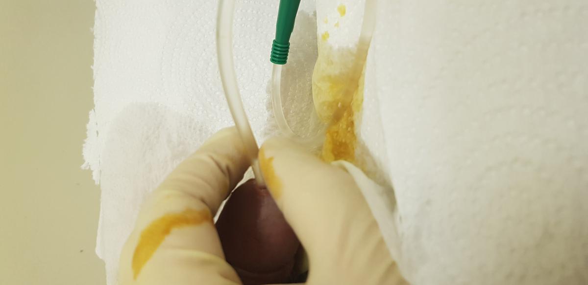 УЗТ при инстилляции в уретру узт инстилляция