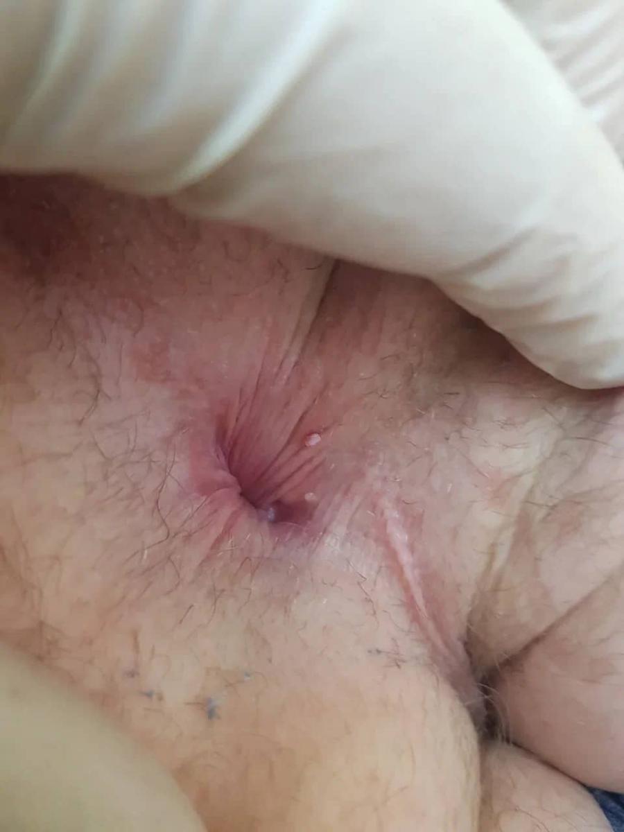 удаление кондилом после массажа