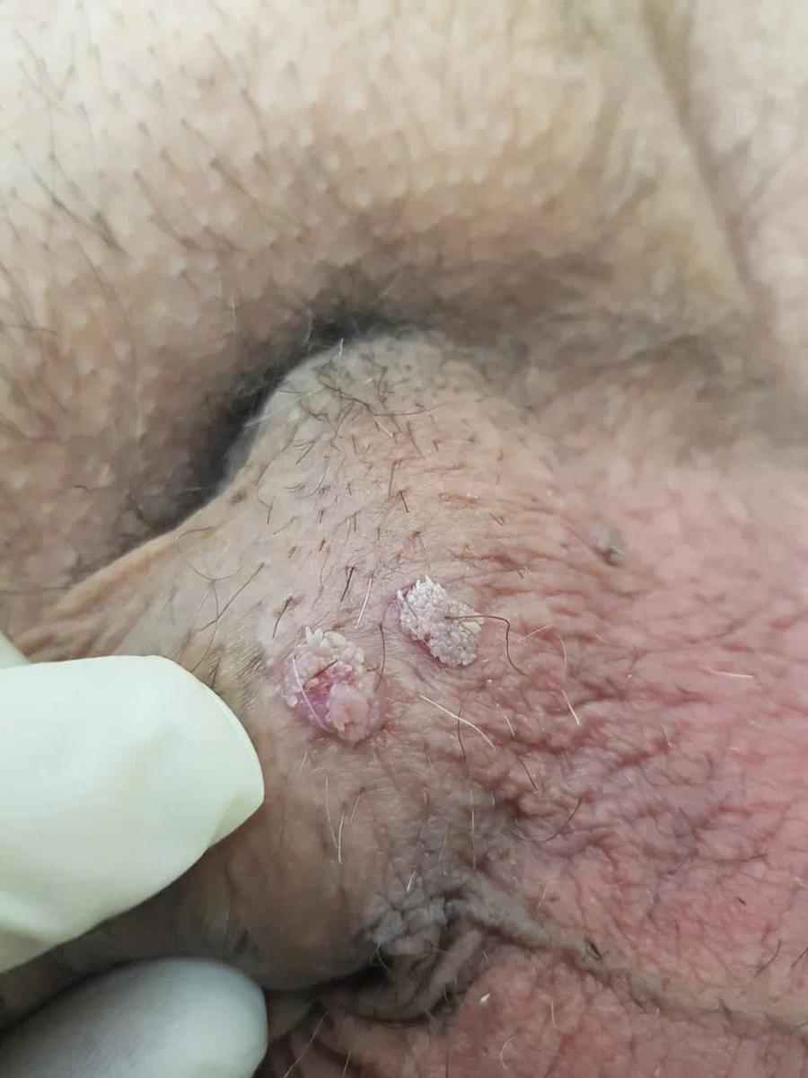 мягкие фибромы мягкие фибромы