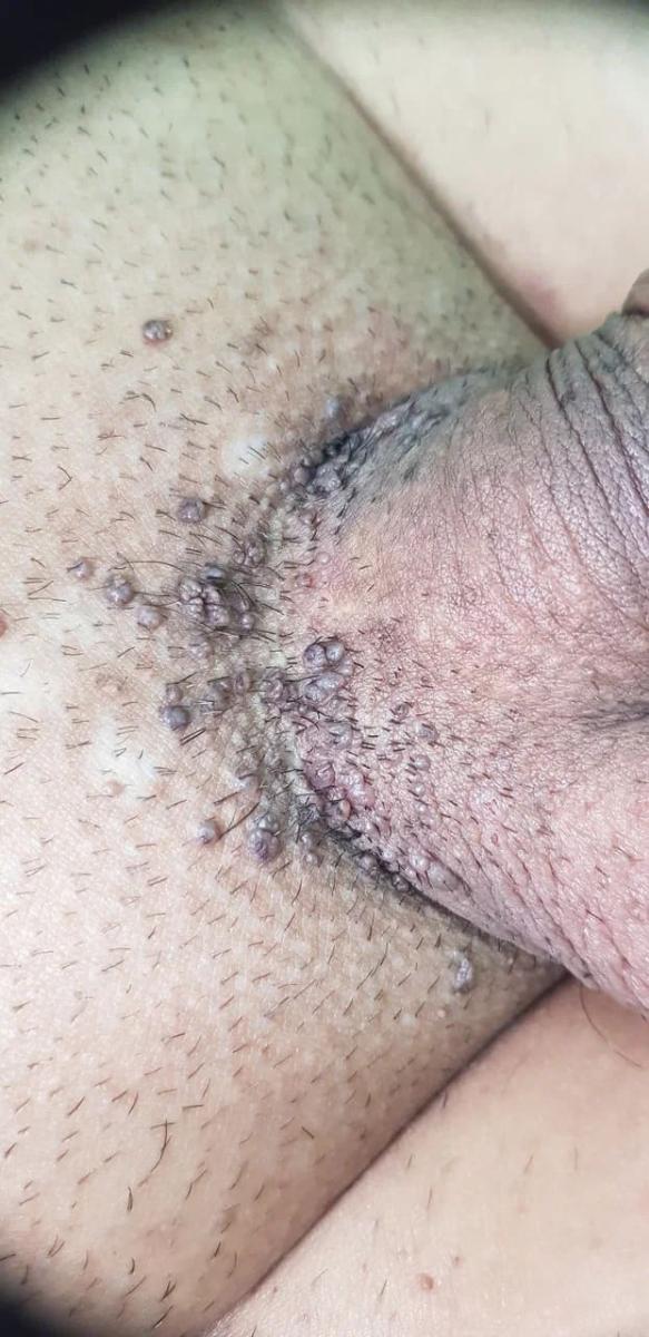 ВПЧ 6 и 11 типа