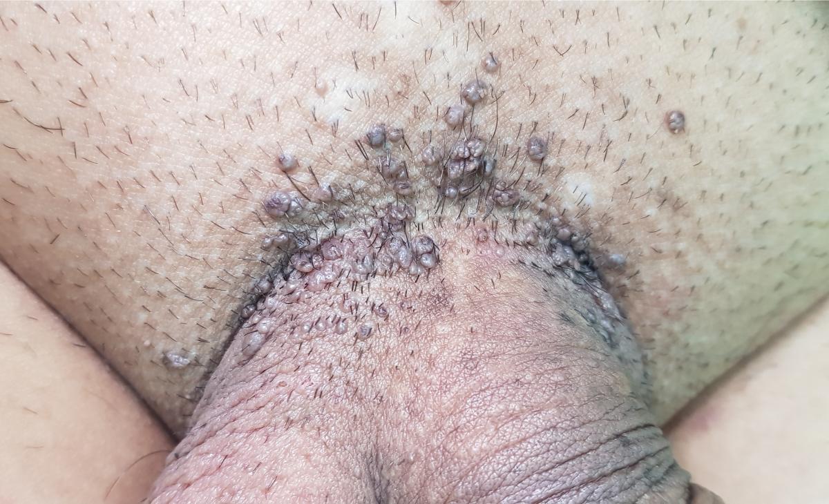 ВПЧ симптомы