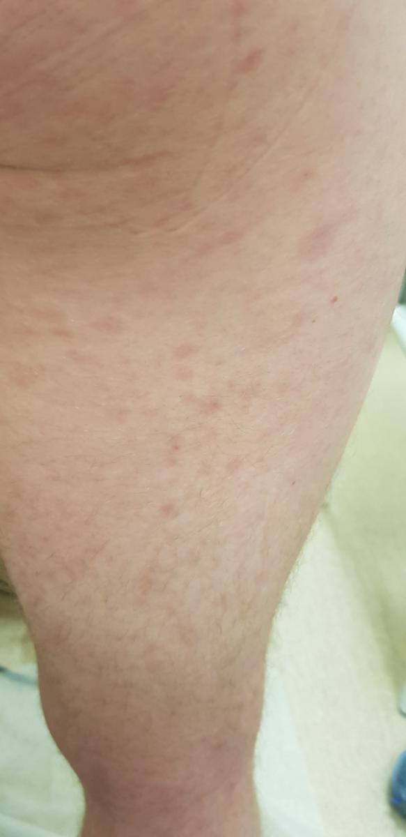 врач выявляет сифилис при осмотре 