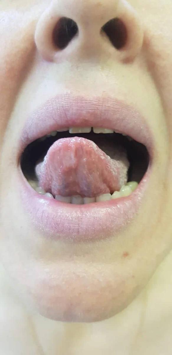 вторичный  сифилис шанкр во рту