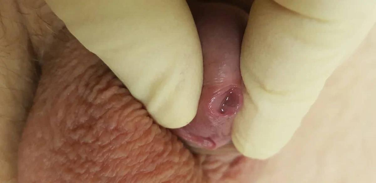 заражение уреаплазмой