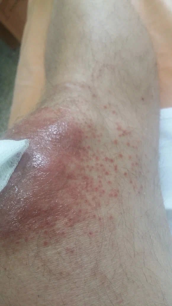 поражение суставов как осложнения гарднереллеза