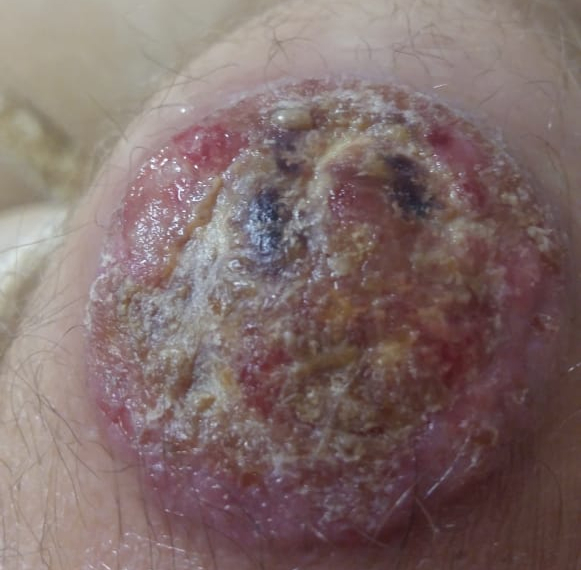 Язва на колене Язва на колене