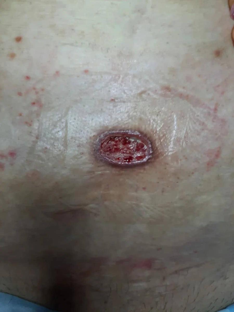 Язвы при диабете