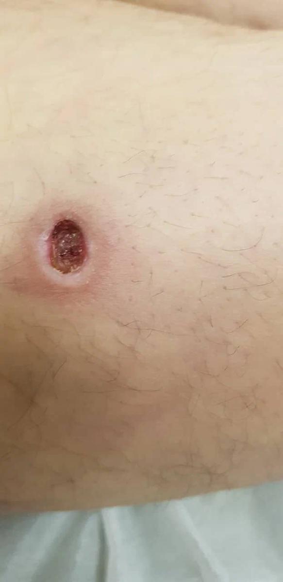 Гуммы при третичном сифилисе