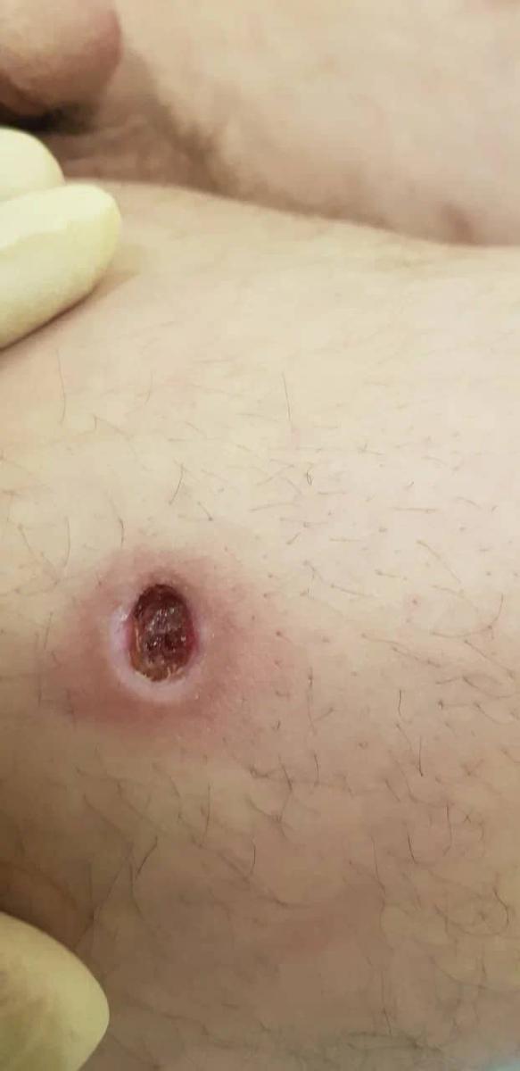 язвы метадона