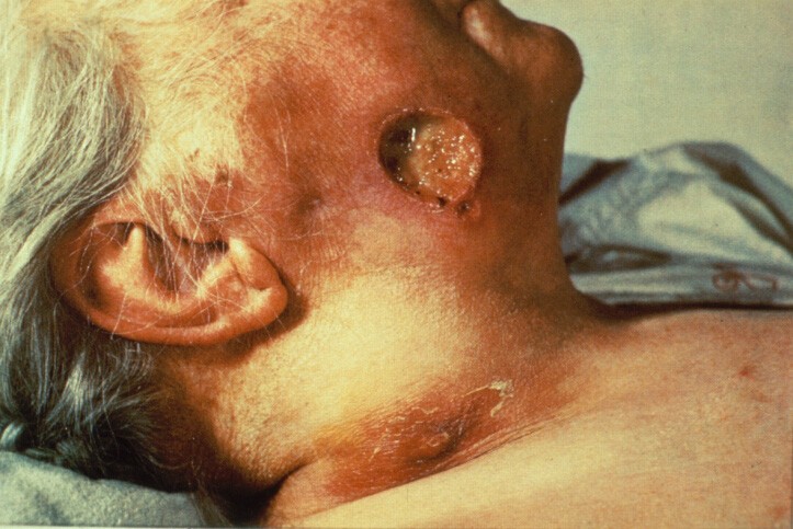 язва на лице при третичном сифилисе