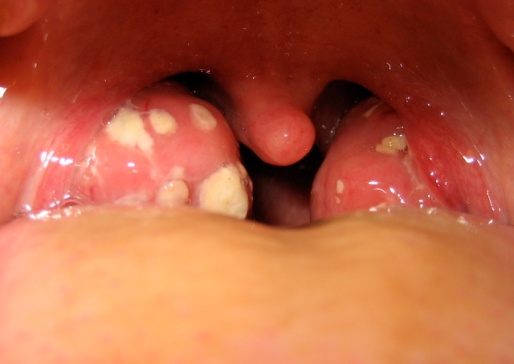  хламидии во рту