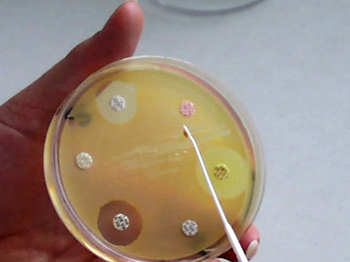 посев мочи на бактерии при пиелонефрите